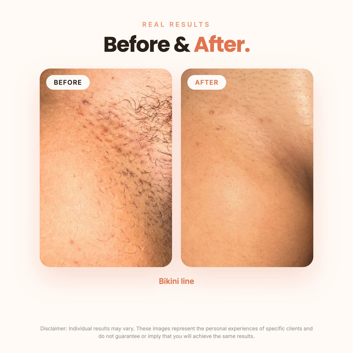 Bikini Line Smoothing & Brightening Serum