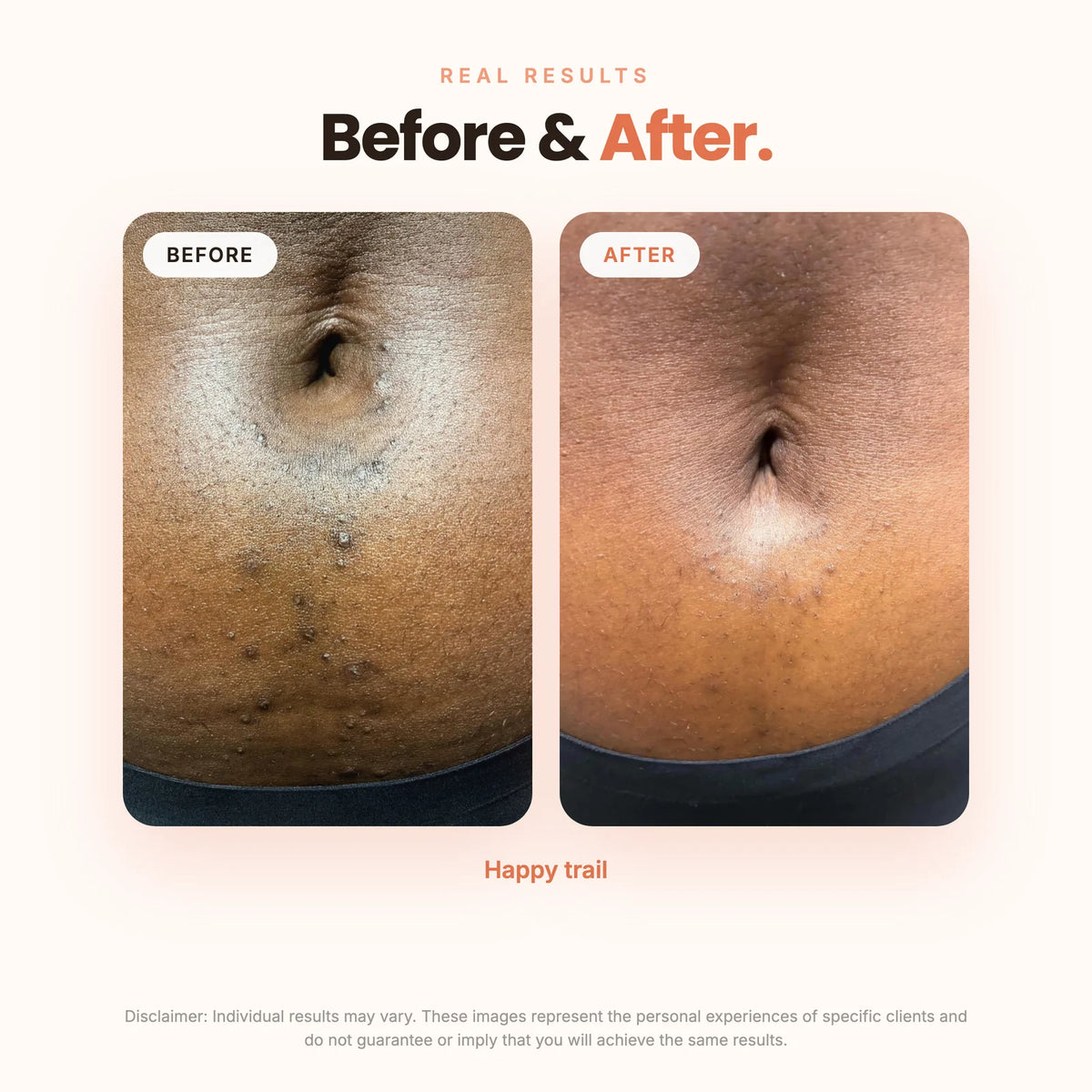 Bikini Line Smoothing & Brightening Serum
