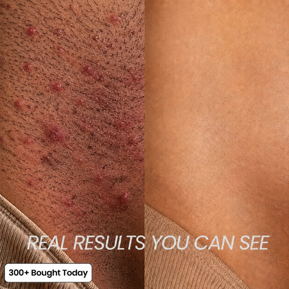 Cyperus Rotundus - Stop Unwanted Hair Growth Naturally